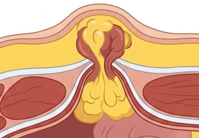 Imagen que representa grasa abdominal