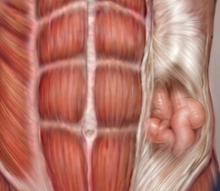 Imagen hernia lateral