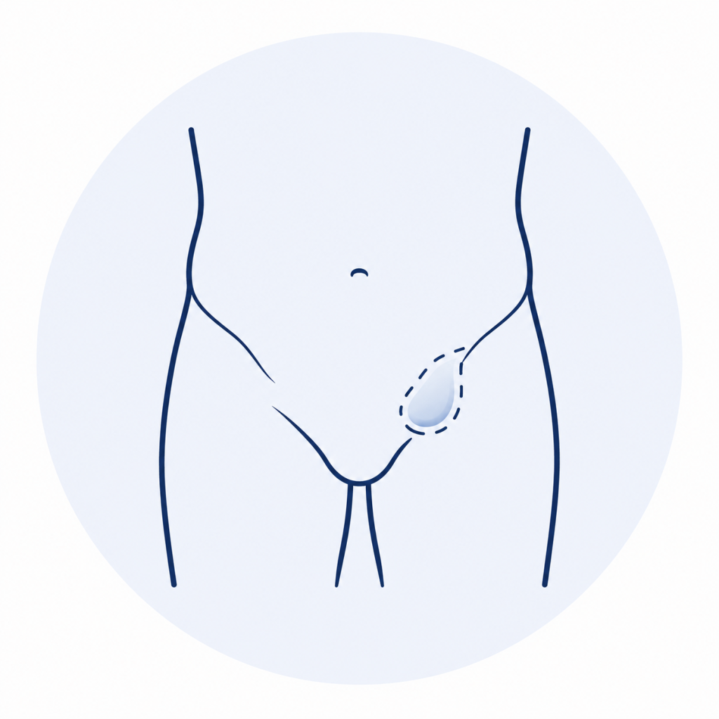 Ilustración médica de hernia inguinal