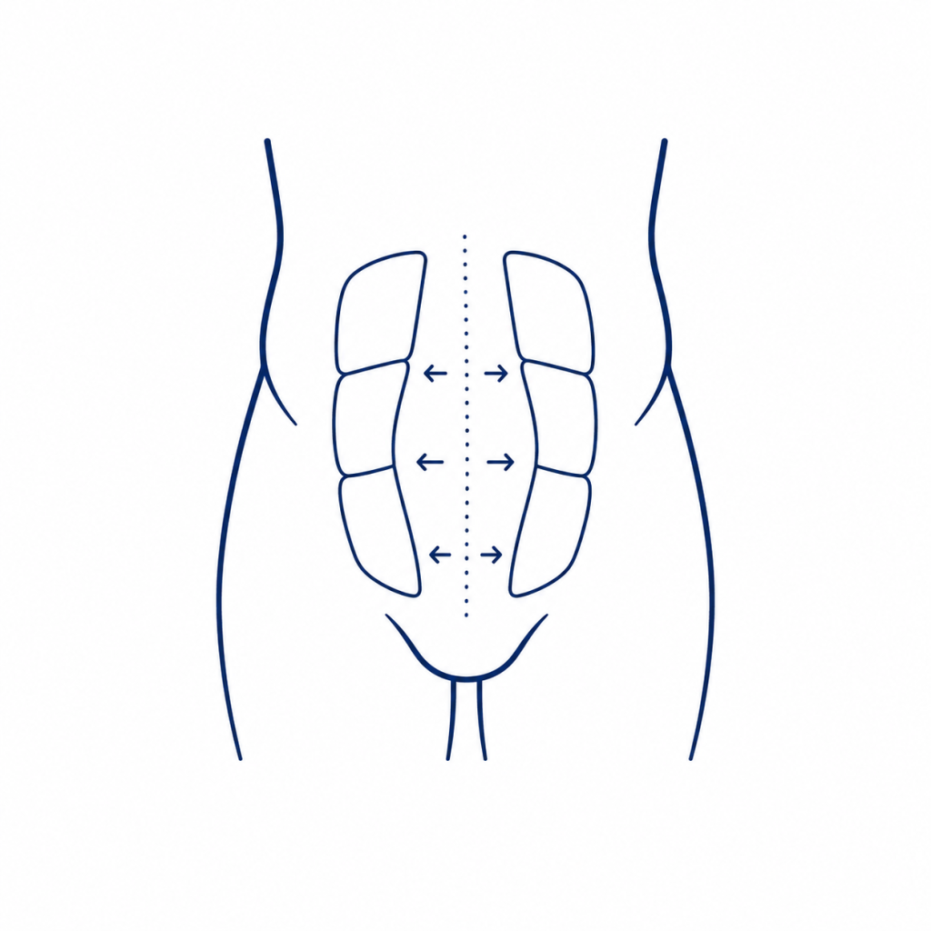 Ilustración médica de separación abdominal