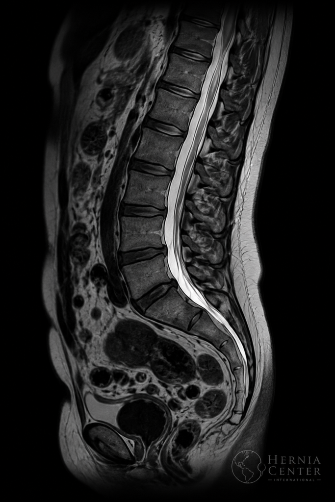 Resonancia lumbar en escala de grises