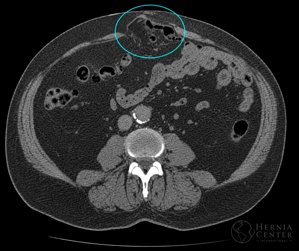 TC abdominal axial con región herniaria destacada