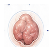 edema de contenido