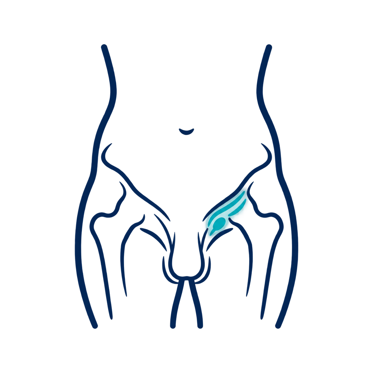 hernia inguinal
