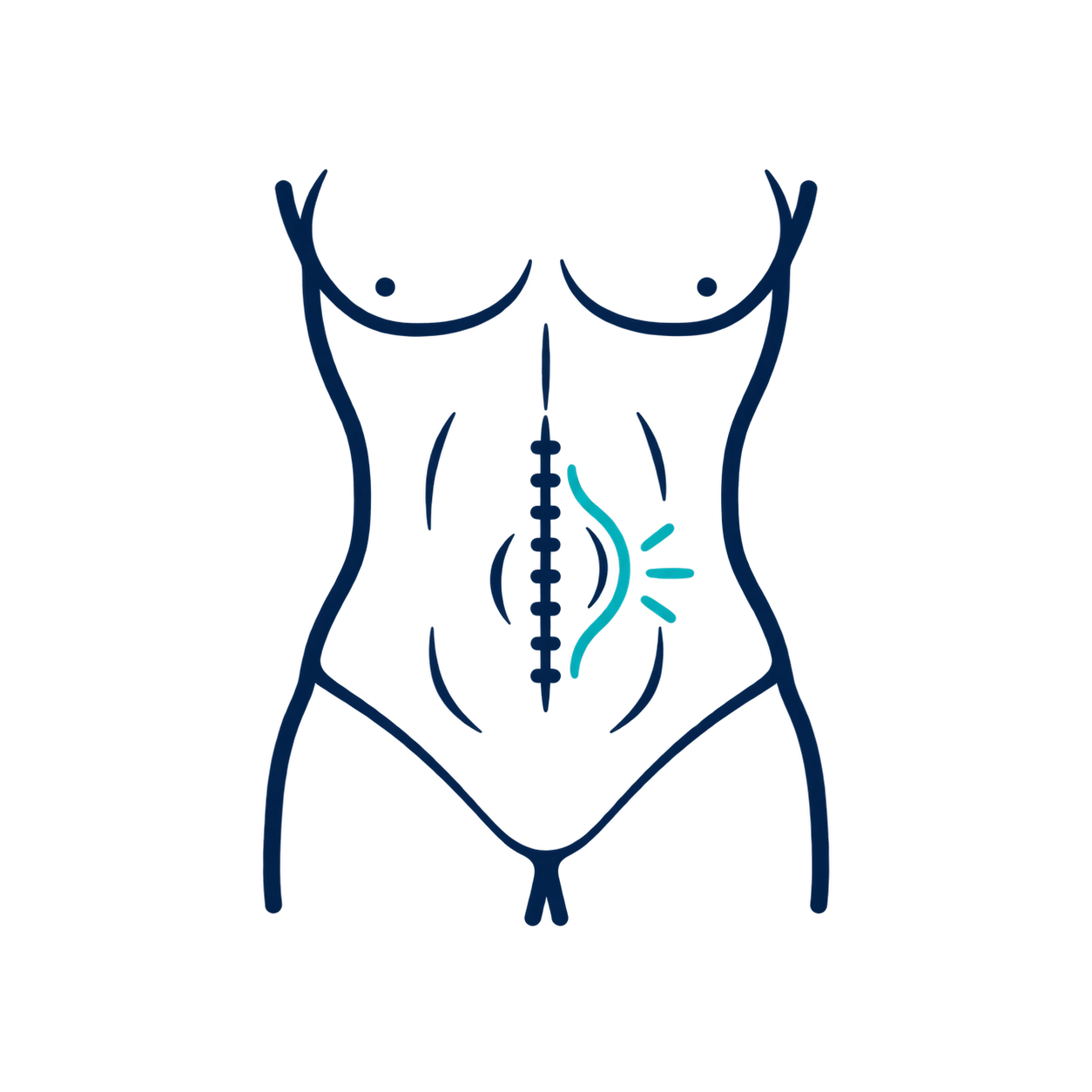 Eventracion