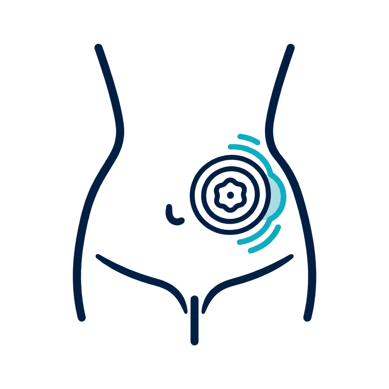 Hernias paraestomales